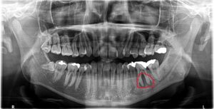 根尖病変が認められる歯のレントゲン写真